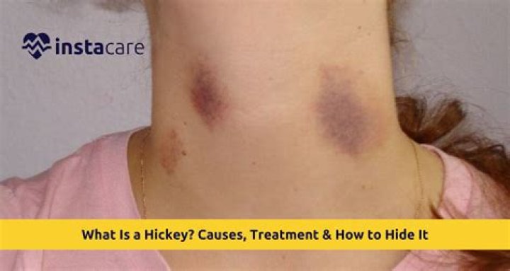 Does Hickey Cause Cancer: Debunking the Myth and Understanding the Truth
