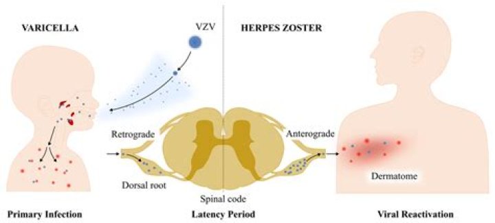 Exploring the Possibilities: Is a Herpes Cure Within Reach?