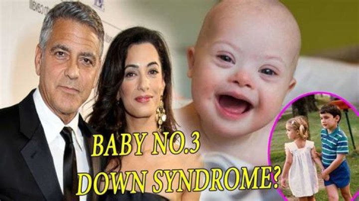 George Clooney's Twins and the Challenge of Down Syndrome