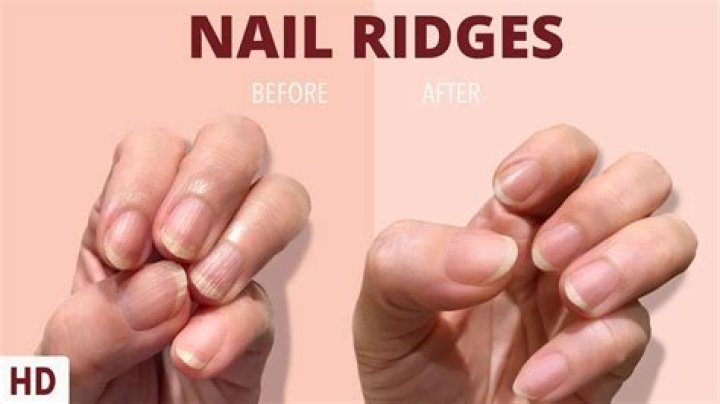 How to Get Rid of Nail Ridges: A Comprehensive Guide