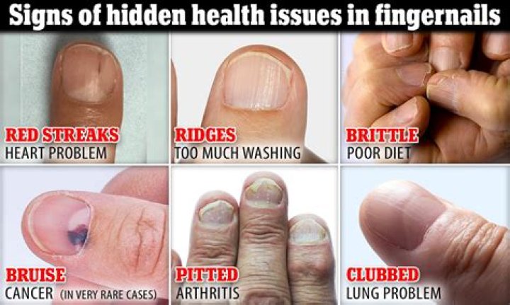 Nail Ridges Cure: Understanding Causes, Treatments, and Prevention