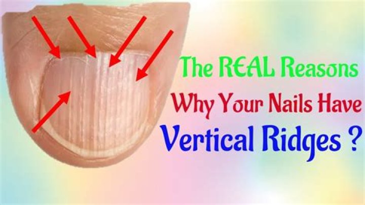 Nail Ridges Remedy: Comprehensive Guide to Understanding and Treating Nail Ridges